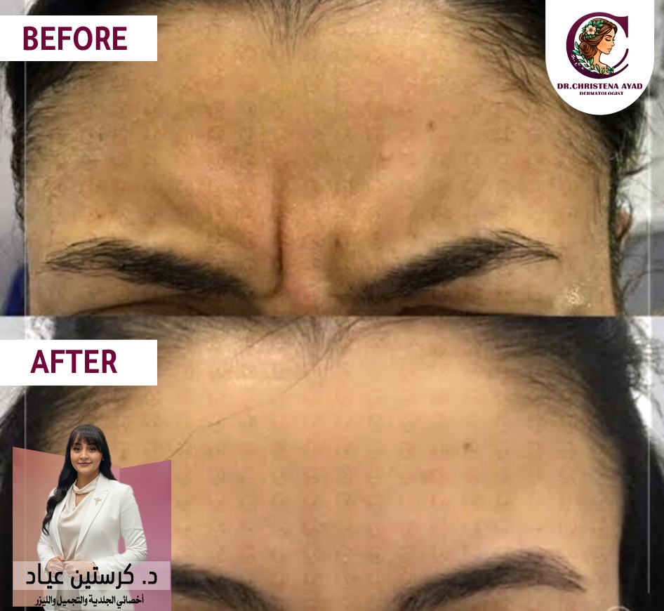 تجاعيد الجبهة