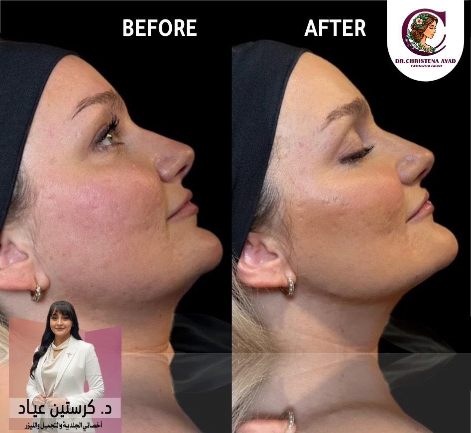 نتيجة تحديد الفك 3