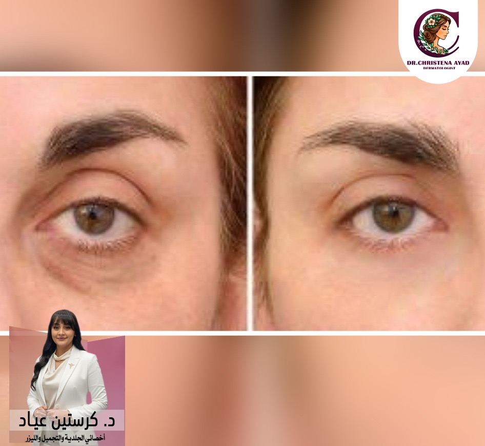 نتيجة فيلر تحت العين 2