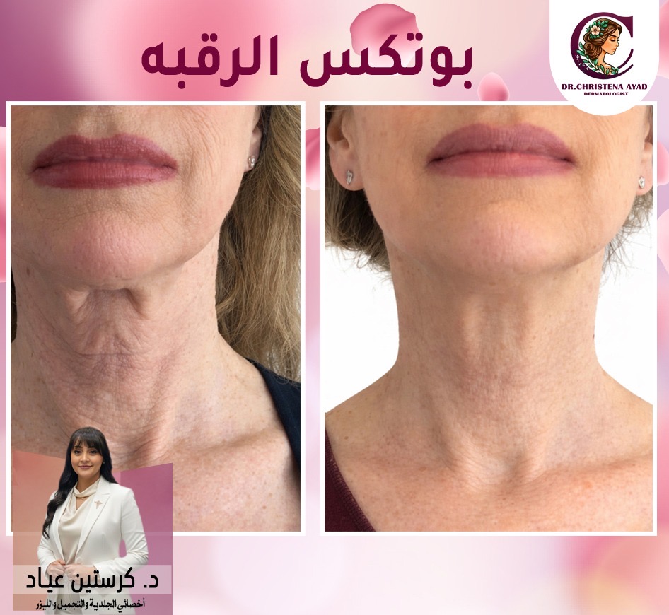 بوتكس الرقبة