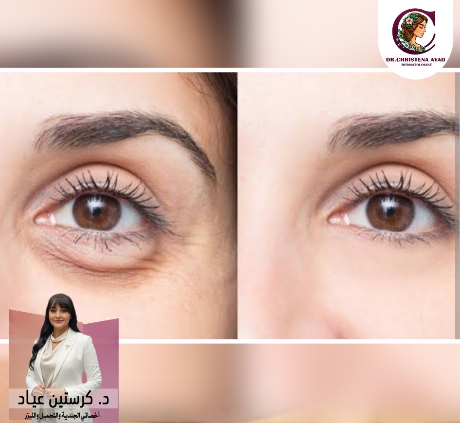 علاج الهالات السوداء