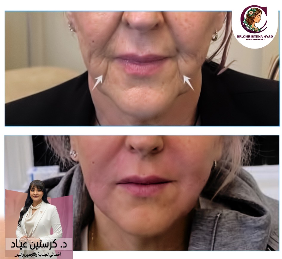 فيلر خطوط الابتسامة 3