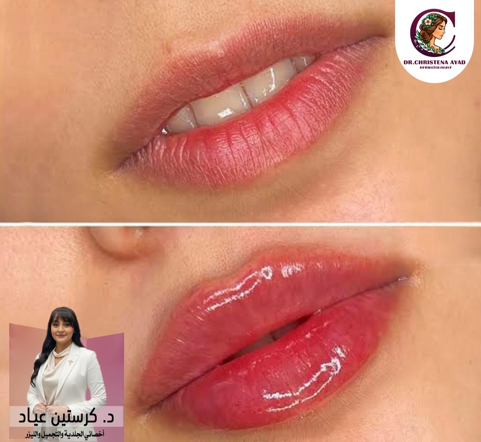 فيلر الشفايف