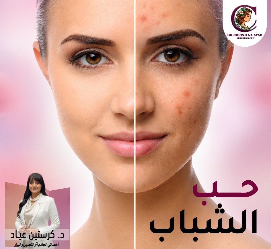 علاج حب الشباب