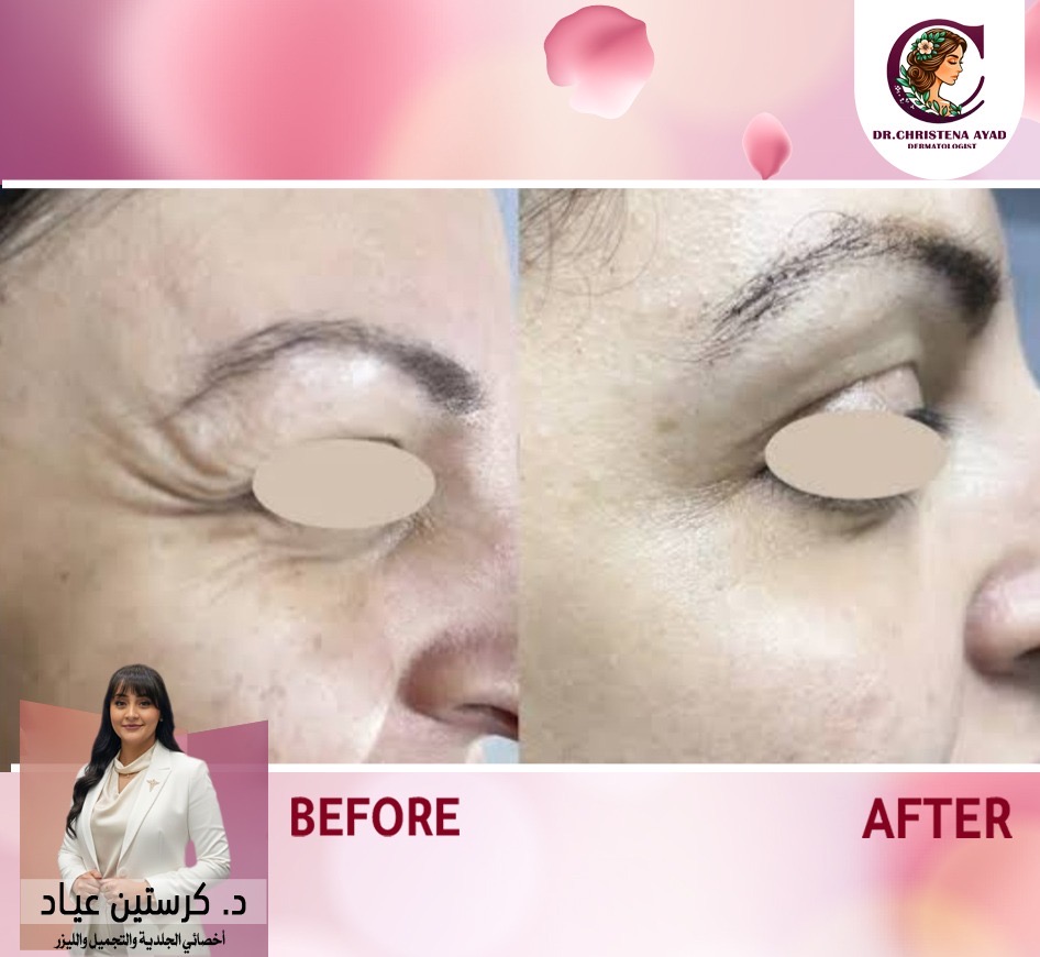 حول العينين