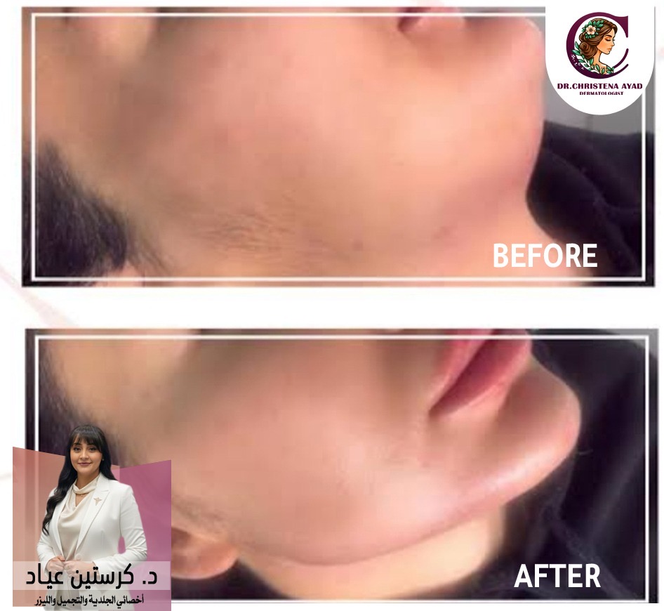 نتيجة تحديد الفك 2