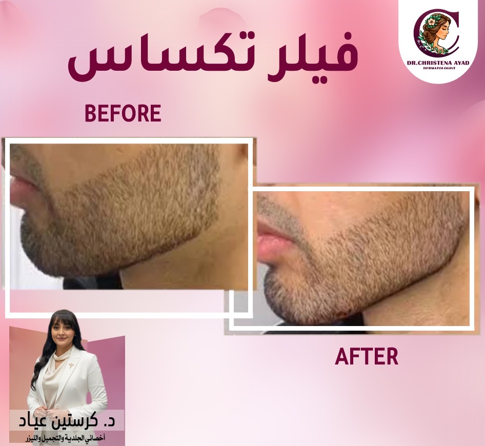 تحديد الفك والوجنتين