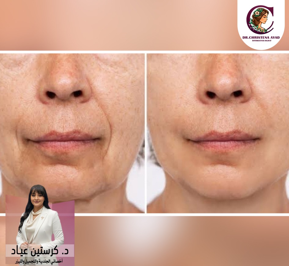 فيلر خطوط الابتسامة 2