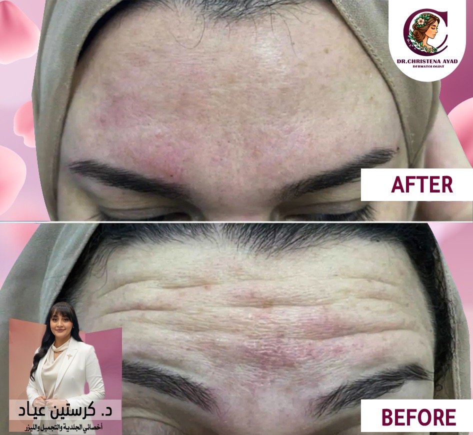 نتائج حقن البوتكس الطبيعية