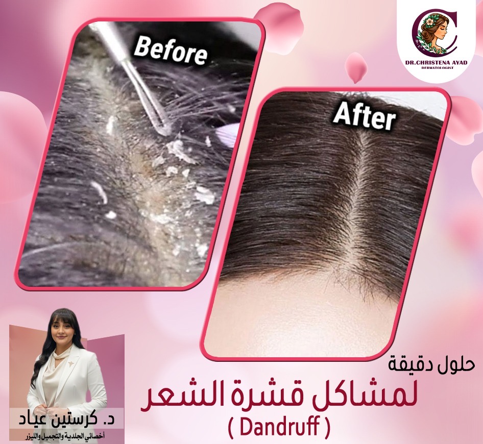 Dandruff Treatment before and after