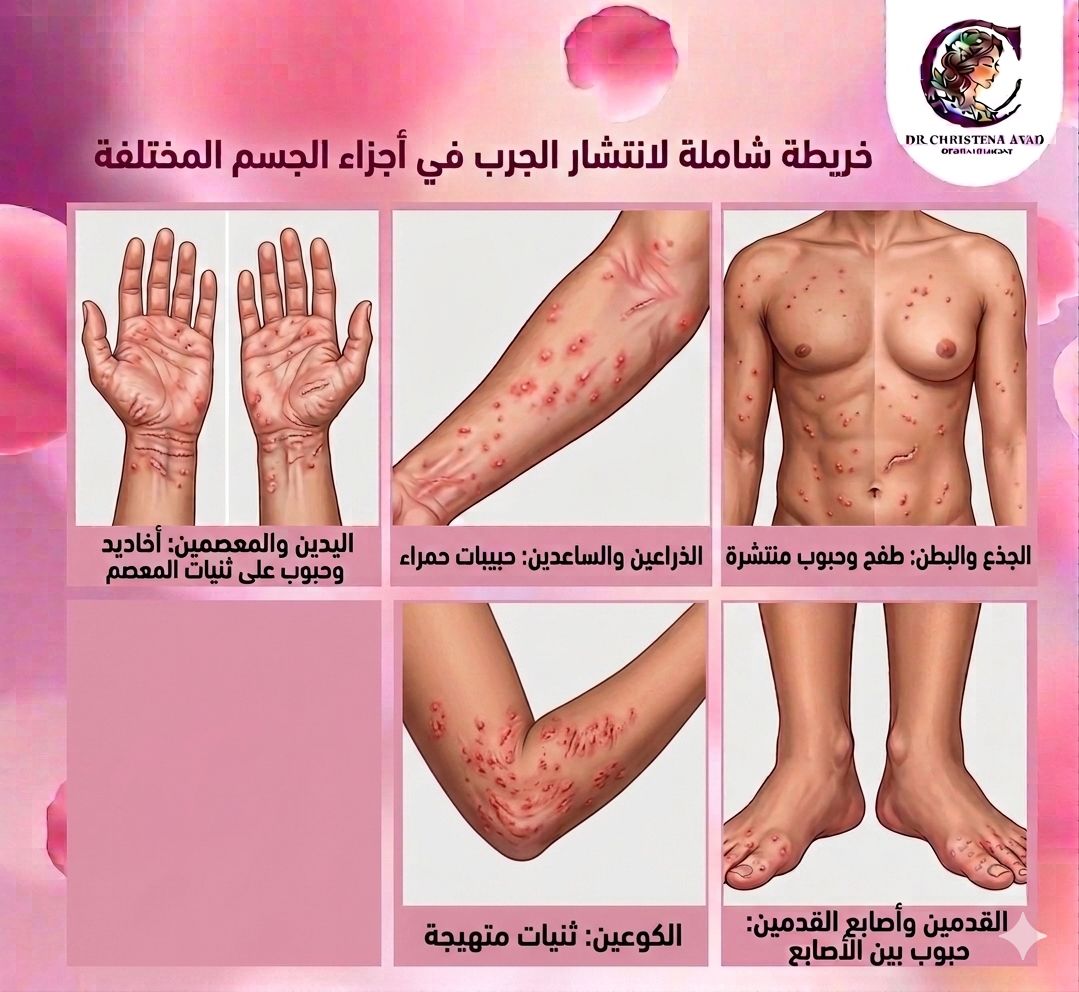 أعراض الجرب