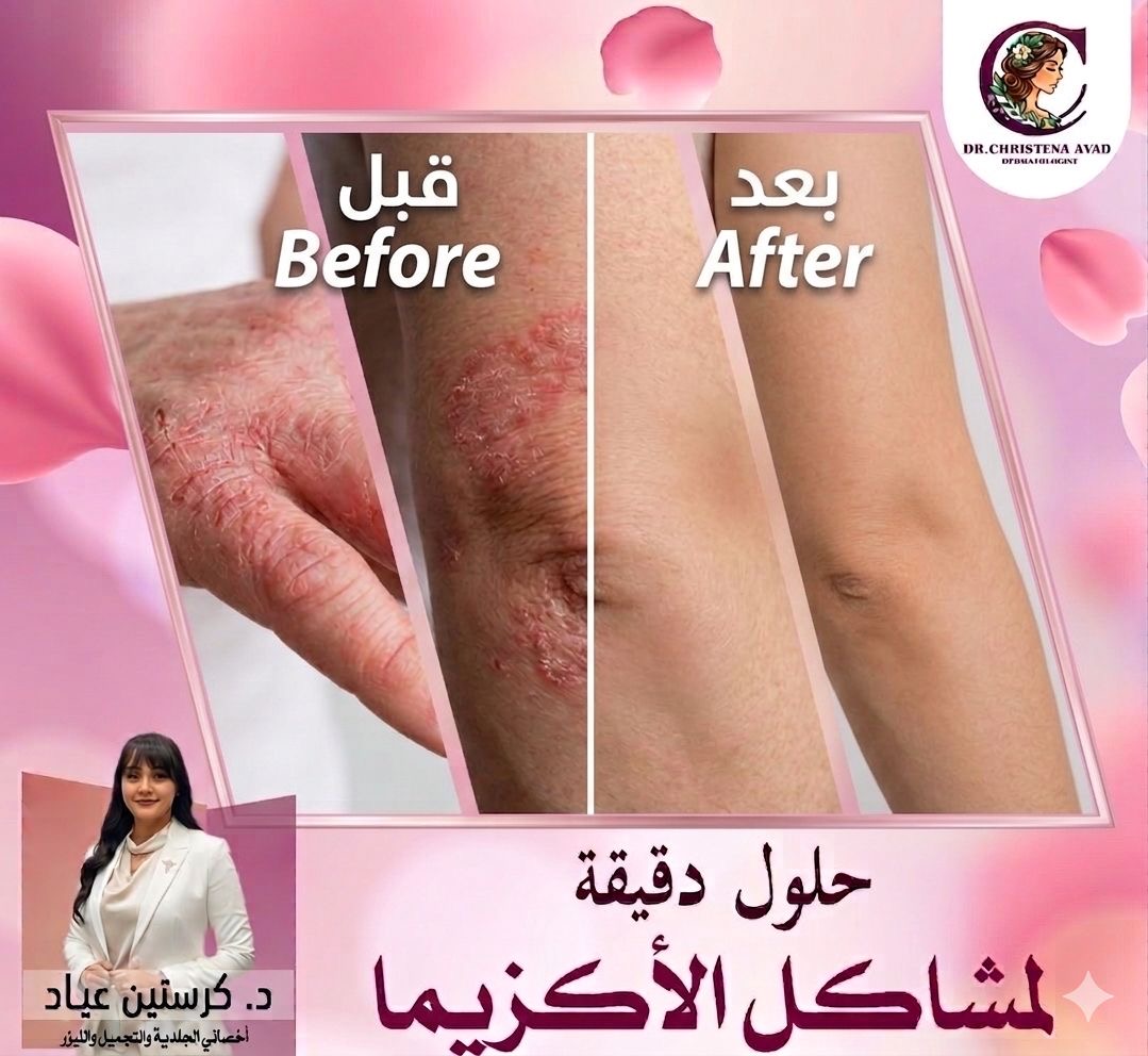علاج الإكزيما اليد قبل وبعد