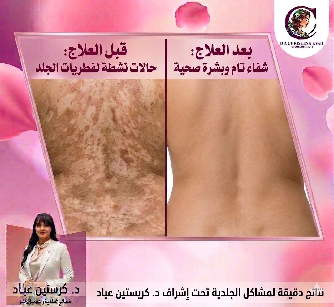 Skin Fungal Treatment before and after