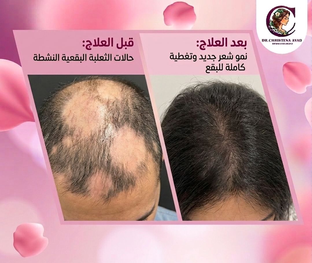 Alopecia Treatment before and after