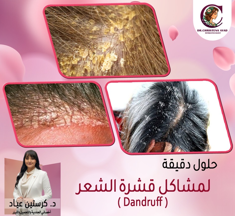 Dandruff Treatment