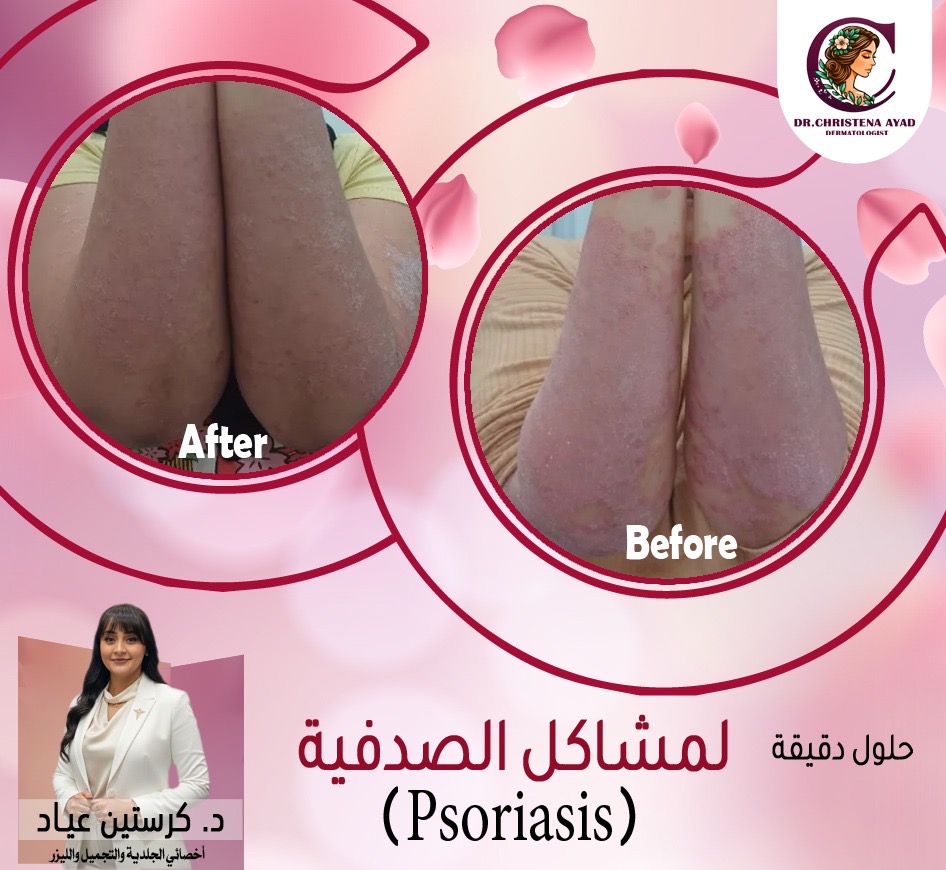 نتائج علاج الصدفية