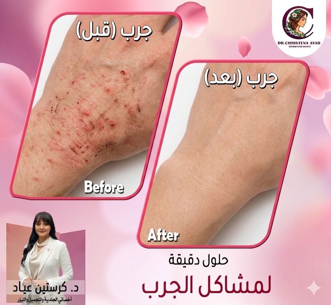 نتائج علاج الجرب قبل وبعد