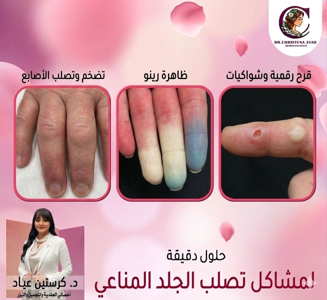 أعراض تصلب الجلد المناعي