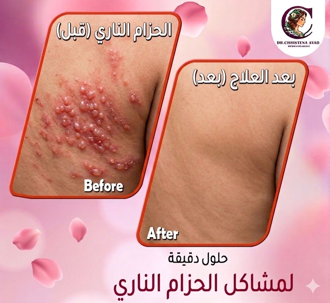 نتائج علاج الحزام الناري قبل وبعد