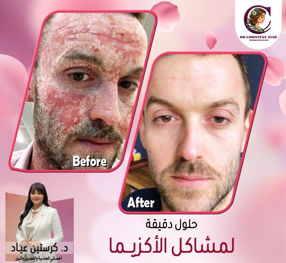 Eczema Treatment
