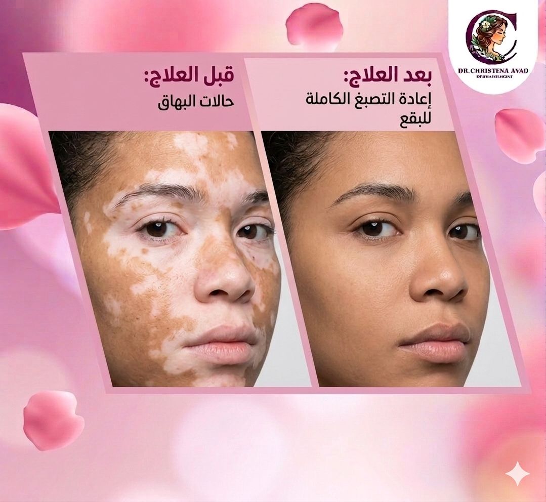 نتائج علاج البهاق قبل وبعد
