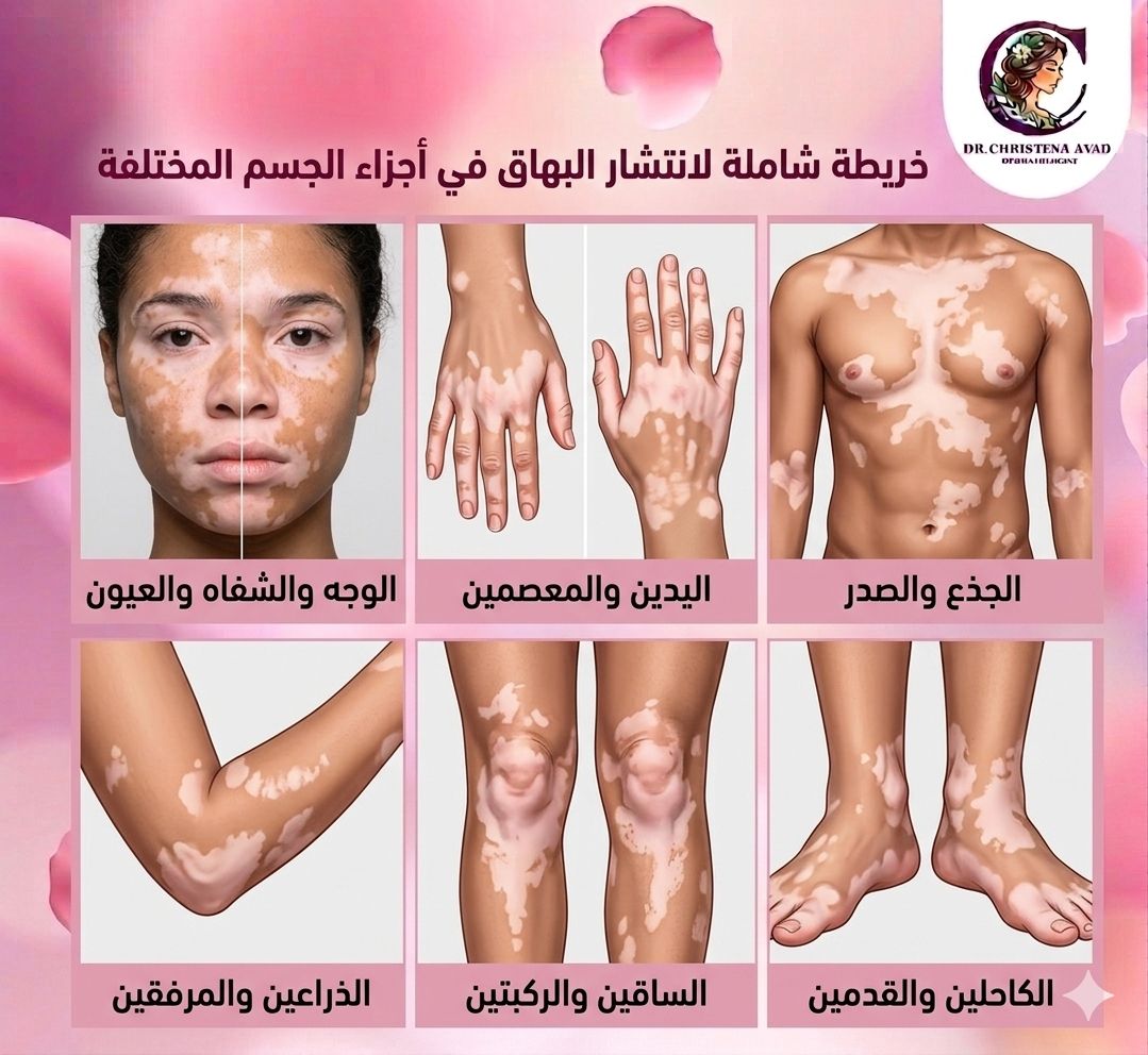 أشكال البهاق في الجسم