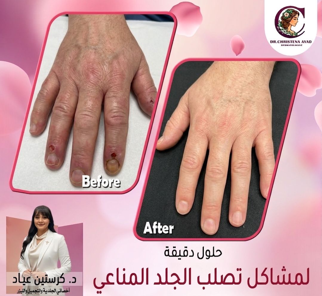 نتائج علاج تصلب الجلد قبل وبعد